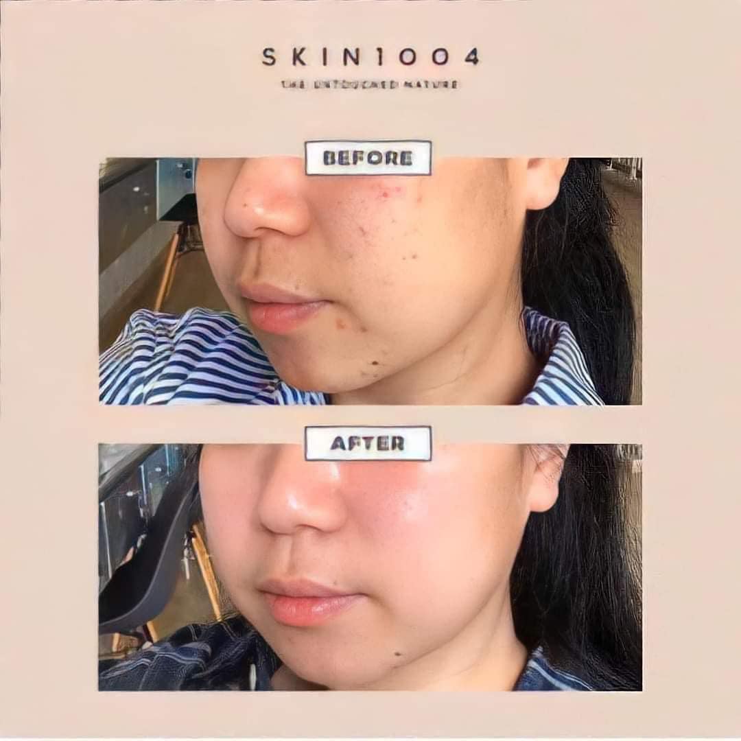 Kem Dưỡng Skin1004 Cho Da Mụn Và Nhạy Cảm Madagascar Centella Cream 4